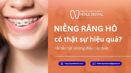 Niềng răng hô có thật sự hiệu quả? Tất tần tật những điều cần biết