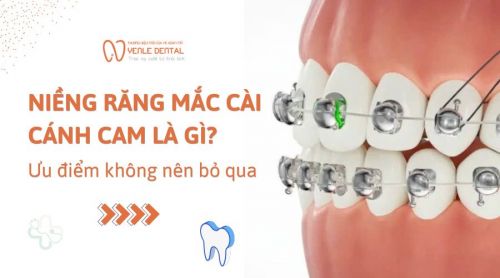 Niềng răng mắc cài cánh cam là gì? 5 Ưu điểm không nên bỏ qua