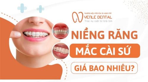 Niềng răng mắc cài sứ giá bao nhiêu? Cập nhật bảng giá mới nhất