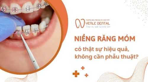 Niềng răng móm có thực sự hiệu quả, không cần phẫu thuật?