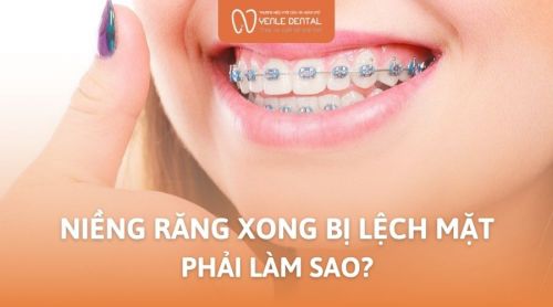 Niềng răng xong bị lệch mặt có sao không? Cách khắc phục như thế nào?