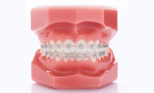 Niềng Răng Mắc Cài Tự Buộc Là Gì? 4 Lý Do Bạn Nên Lựa Chọn