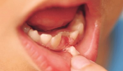 NHỔ RĂNG SỮA QUÁ SỚM – CÓ ẢNH HƯỞNG ĐẾN RĂNG VĨNH VIỄN KHÔNG?