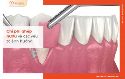 Chi phí ghép nướu và các yếu tố ảnh hưởng