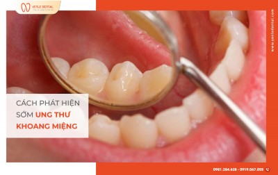 KHÁM RĂNG ĐỊNH KỲ – CÁCH PHÁT HIỆN SỚM UNG THƯ KHOANG MIỆNG