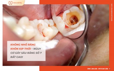 Không nhổ răng khôn kịp thời – Nguy cơ gây sâu răng số 7 rất cao