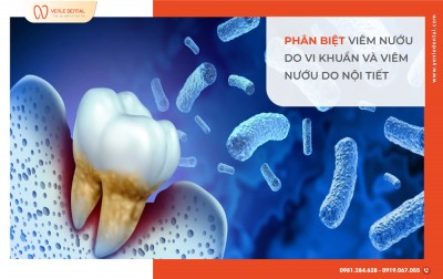 PHÂN BIỆT VIÊM NƯỚU DO VI KHUẨN VÀ VIÊM NƯỚU DO NỘI TIẾT – ĐỂ KHÔNG NHẦM LẪN!