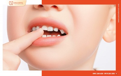 TẬT ĐẨY LƯỠI, MÚT TAY Ở TRẺ – “THỦ PHẠM” THẦM LẶNG GÂY LỆCH RĂNG