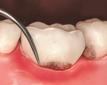 VÔI RĂNG DƯỚI LỢI – XỬ LÝ BẰNG MÁY SIÊU ÂM HAY NẠO TÚI NHA CHU?