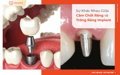 CẮM CHỐT RĂNG VÀ TRỒNG RĂNG IMPLANT – NÊN CHỌN PHƯƠNG ÁN NÀO?