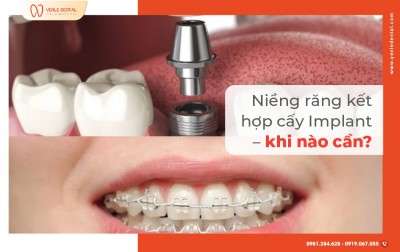 NIỀNG RĂNG KẾT HỢP CẤY IMPLANT – KHI NÀO CẦN?