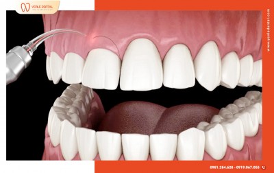 Hiểu Thế Nào Về Kỹ Thuật Định Hình & Tạo Viền Răng?