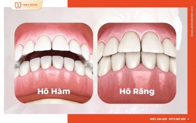 Hô do răng hay hô do hàm – Phân biệt sao cho đúng?