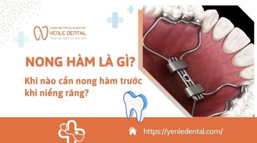 Nong hàm là gì? Khi nào cần nong hàm trước khi niềng răng?
