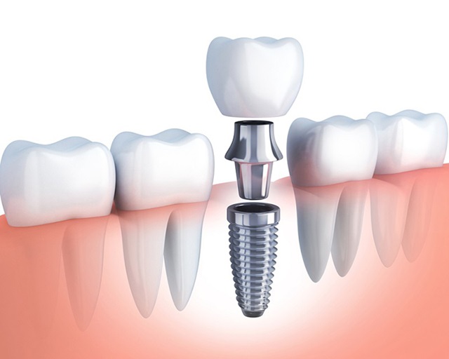 Phẫu thuật cấy ghép implant