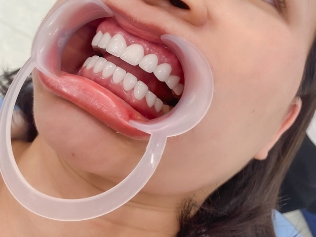 Quá trình bọc sứ kim loại