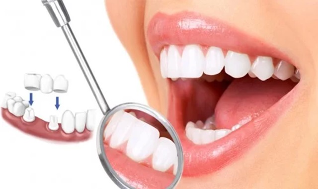 Quá trình bọc sứ zirconia