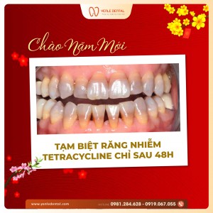 Chào Năm Mới! TẠM BIỆT RĂNG NHIỄM TETRACYCLINE CHỈ SAU 48H VỚI GIẢI PHÁP BỌC RĂNG SỨ