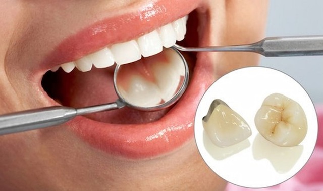 Răng sứ từ kim loại có độ bền cao