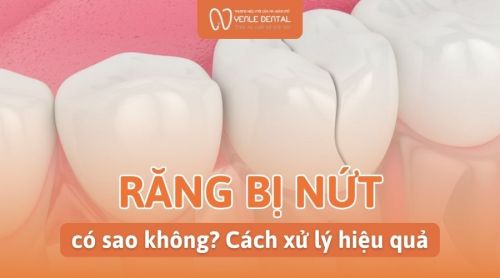 Răng bị nứt có sao không? Cách xử lý hiệu quả