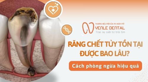 Răng chết tủy tồn tại được bao lâu? Cách phòng ngừa hiệu quả