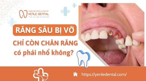 Giải đáp: Răng sâu bị vỡ chỉ còn chân răng có phải nhổ không?
