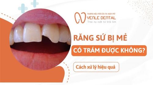 Răng sứ bị mẻ có trám được không? Cách xử lý hiệu quả