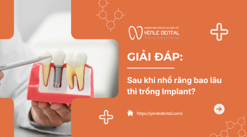 Bác sĩ tư vấn: Sau khi nhổ răng bao lâu thì trồng Implant​?
