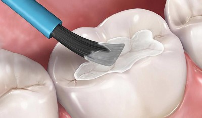 TRÁM RĂNG CÓ GIÚP PHÒNG TRÁNH VIÊM TỦY RĂNG KHÔNG?