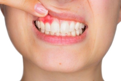 Viêm lợi có niềng răng được không? Giải đáp từ chuyên gia chỉnh nha