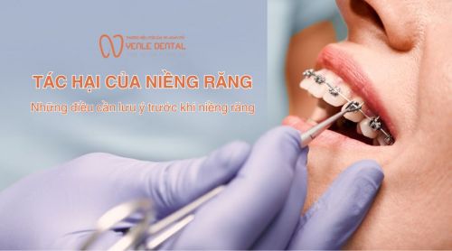 Tác Hại Của Niềng Răng Và Những Điều Cần Lưu Ý Trước Khi Niềng