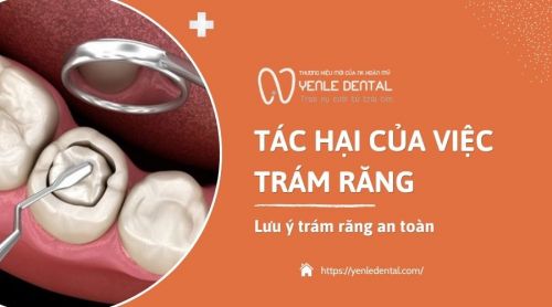 Tác hại của việc trám răng có thể bạn chưa biết