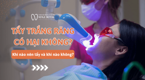 Tẩy trắng răng có hại không? Khi nào nên và không nên tẩy trắng?