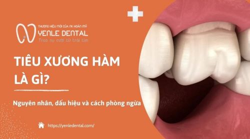 Tiêu xương hàm là gì? Nguyên nhân, dấu hiệu và cách phòng ngừa