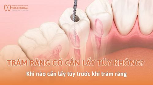 Trám răng có cần lấy tủy không? Khi nào cần lấy tủy trước khi trám răng