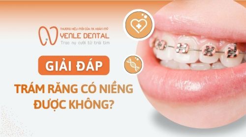 Răng trám có niềng được không? Những lưu ý cần biết