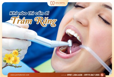 Trám răng đón Tết – Rạng rỡ nụ cười trong những ngày xuân