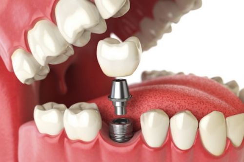 BÁC SĨ TRỒNG RĂNG IMPLANT GIỎI – CHÌA KHÓA CHO MỘT CA CẤY GHÉP THÀNH CÔNG