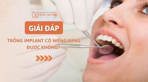 Giải đáp: Trồng Implant có niềng răng được không? 