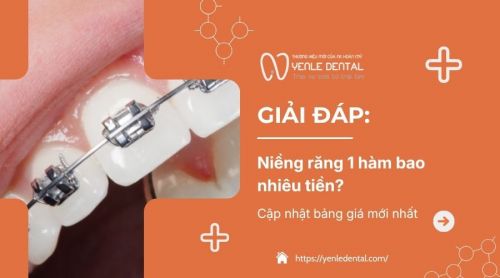 Niềng răng 1 hàm bao nhiêu tiền? Cập nhật bảng giá mới nhất