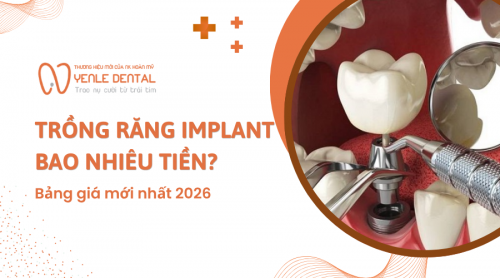 Trồng răng Implant bao nhiêu tiền? Bảng giá mới nhất 2026