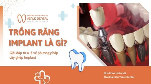 Trồng răng Implant là gì? Giải đáp từ A-Z về phương pháp cấy ghép Implant