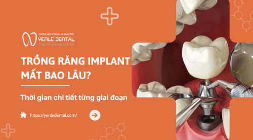 Trồng răng Implant mất bao lâu? Thời gian chi tiết từng giai đoạn