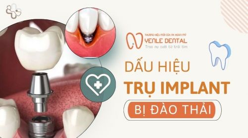 5 Dấu hiệu trụ Implant bị đào thải và cách phòng ngừa hiệu quả