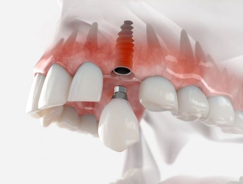 Trồng Răng Implant Bao Lâu Thì Hoàn Thành? 6 Yếu Tố Quyết Định Bạn Cần Biết