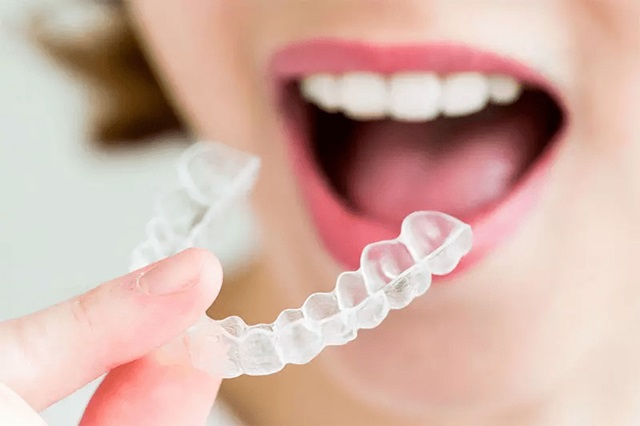 Tuân theo quy định của nha sĩ về việc niềng răng