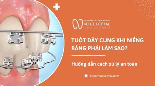 Tuột dây cung khi niềng răng phải làm sao? Hướng dẫn xử lý an toàn