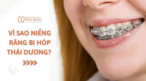 Vì sao niềng răng bị hóp thái dương? 3 Bài tập hỗ trợ cải thiện