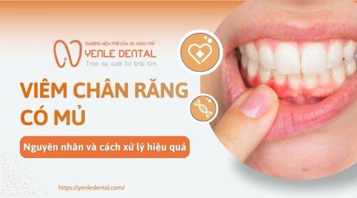 Viêm chân răng có mủ: Nguyên nhân và cách xử lý hiệu quả