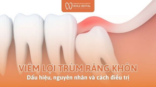 Viêm lợi trùm răng khôn là gì? Dấu hiệu, nguyên nhân và cách điều trị
